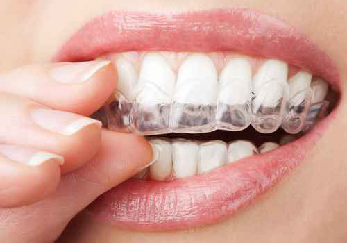 Zahnersatz Zahnschiene