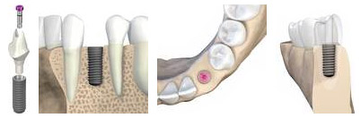 Darstellung Vorgehensweise Zahnimplantate / Zahnersatz