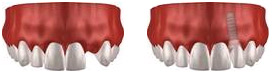 Darstellung 3D Zahnimplantat