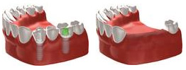 Zahnersatz Zahnimplantate 3d Zeichnung