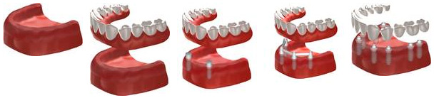 Übersicht Zahnersatz/Zahnimplantate
