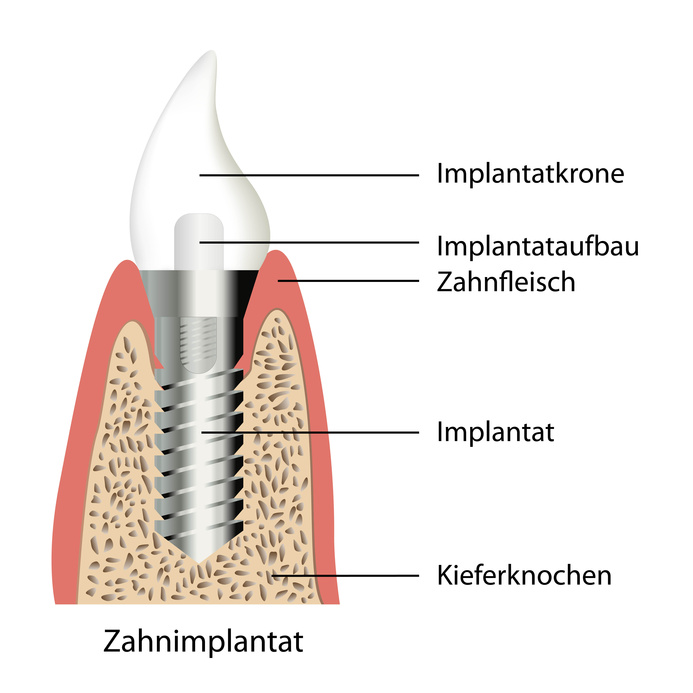 Zahnimplantate Aufbau, Erklärung