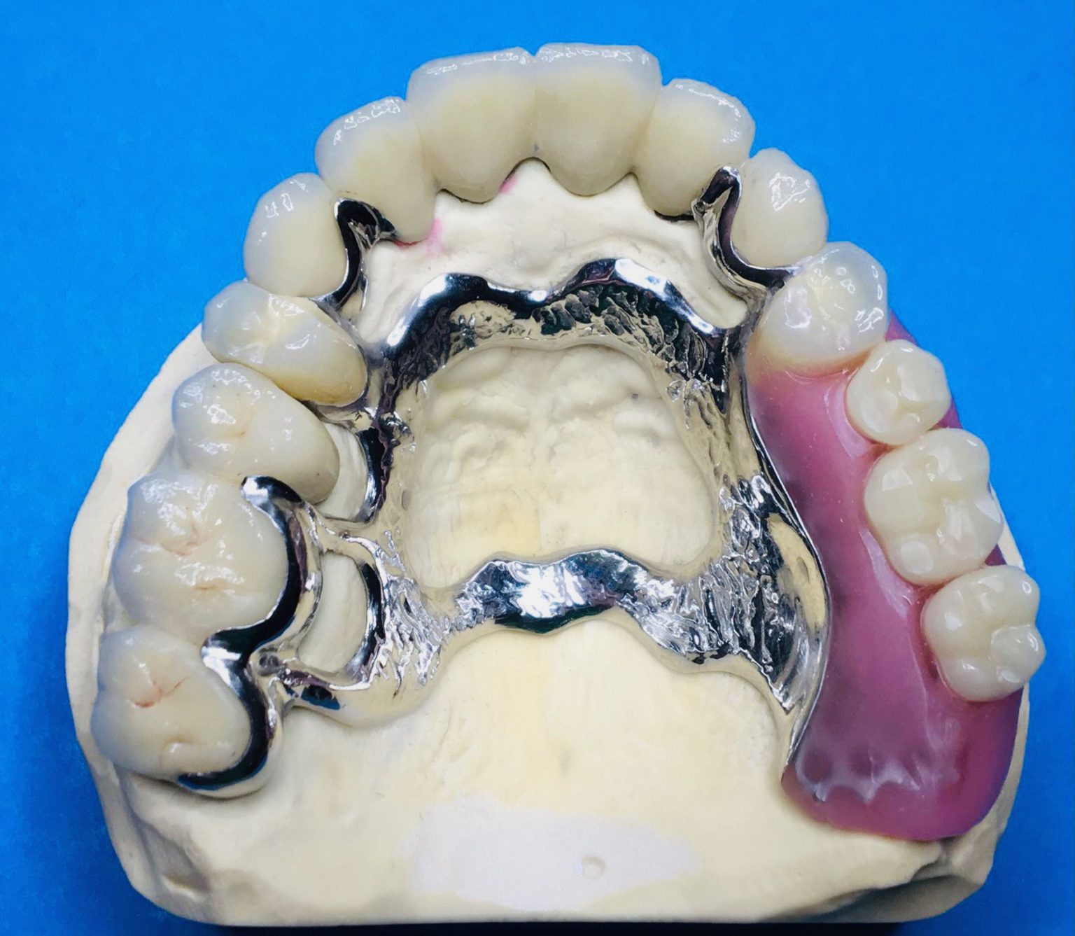 Geschiebeprothese Komplett Flair dent de Geschiebeprothese Komplett Flair dent de